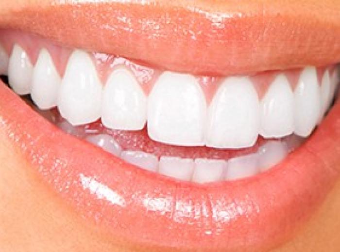 Top 5 Reasons to Get Professional Teeth Cleanings