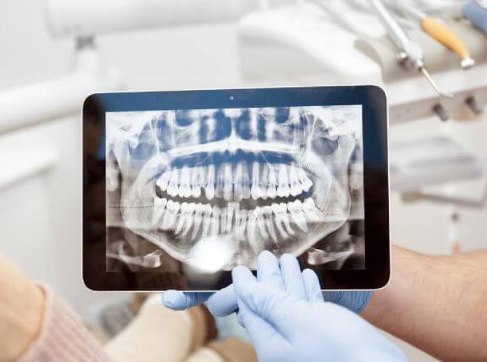 Are Dental X-Rays Safe? Debunking Myths and Addressing Concerns