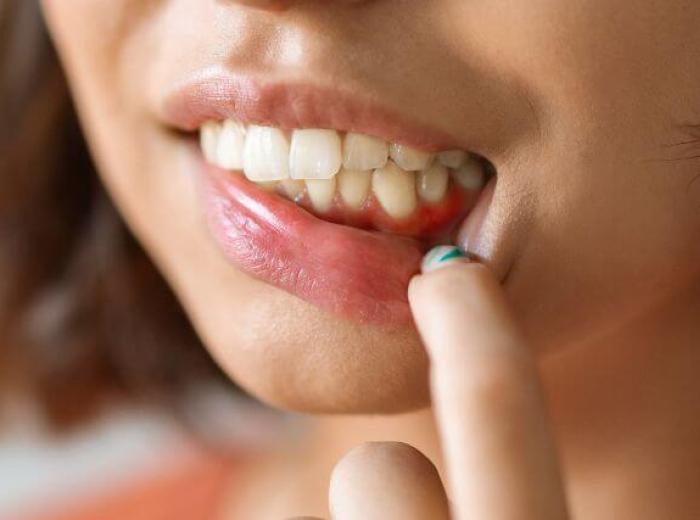 Causes of Gingivitis: Uncovering the Culprits Behind Gum Inflammation