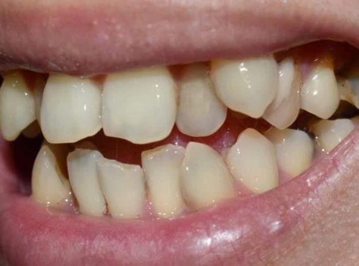 Hyperdontia: Understanding the Phenomenon of Supernumerary Teeth