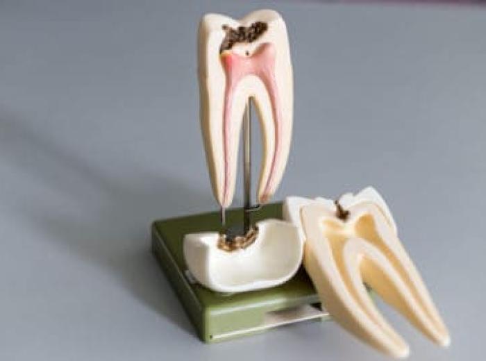 The Not So Scary Truth About Root Canals
