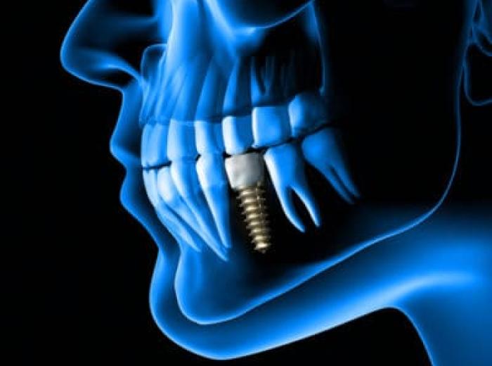 What You Should Know About Dental Implants