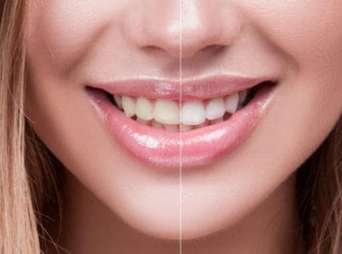 How to Whiten Teeth