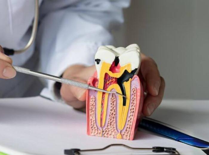 What to Expect During a Root Canal