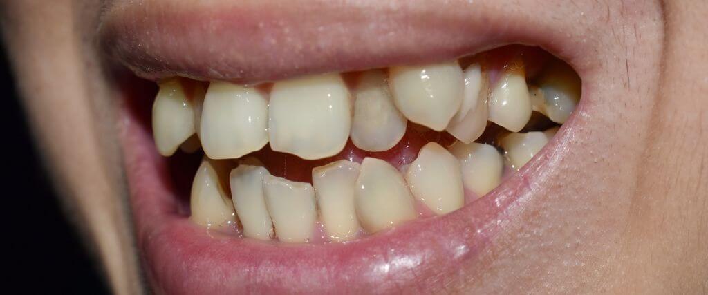 Hyperdontia in human dental services.