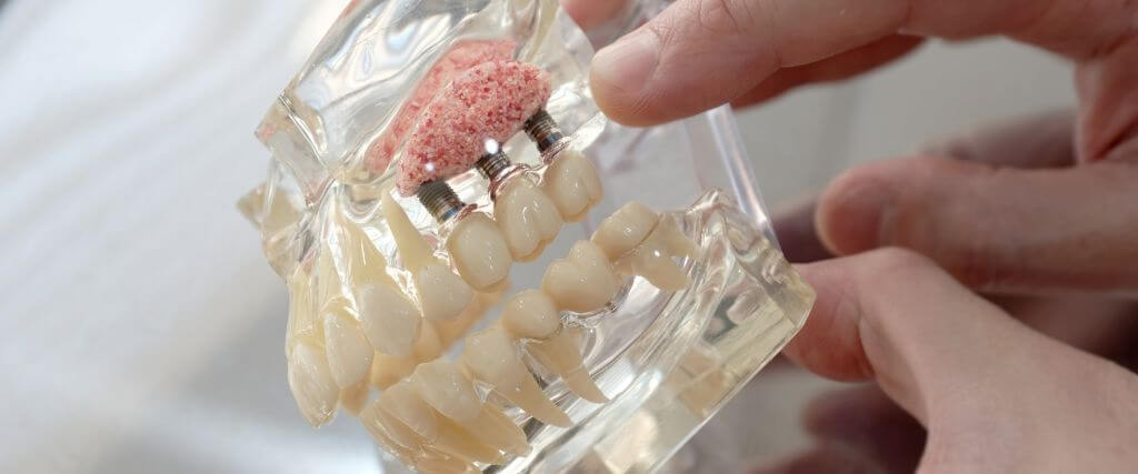 Sinus Lift Surgery: Making Dental Implants Possible