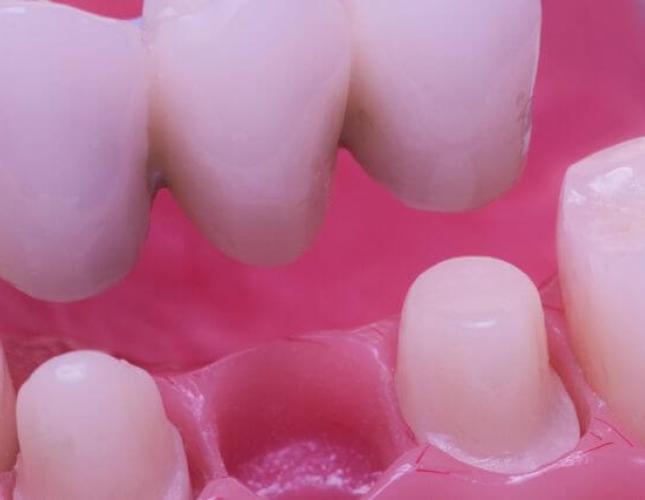 Bridging the Gap: Understanding Dental Bridges in Restorative Dentistry