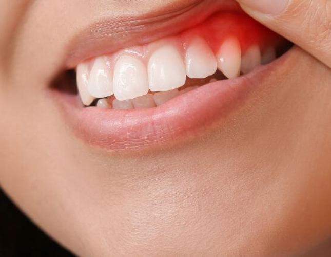 Gingivitis 101: Understanding the Basics of Gum Inflammation