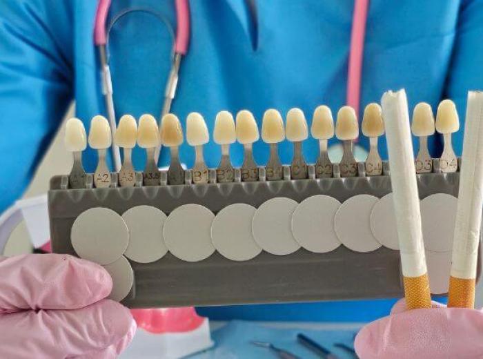 How to Prevent Tooth Staining and Keep Your Smile Bright