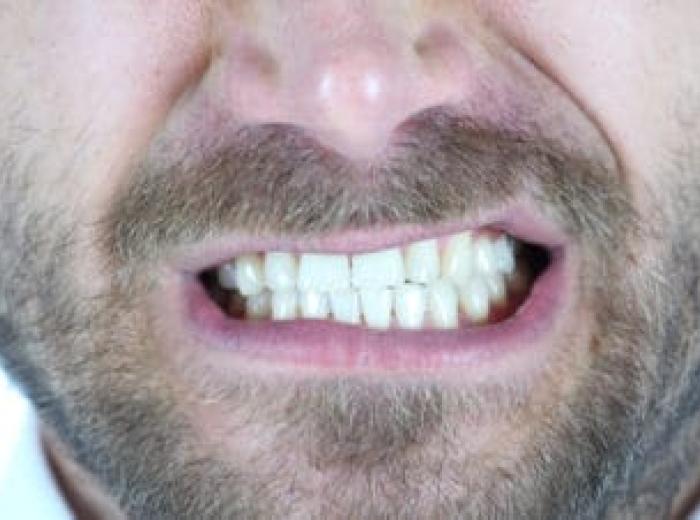 What Are Signs That I Grind My Teeth?