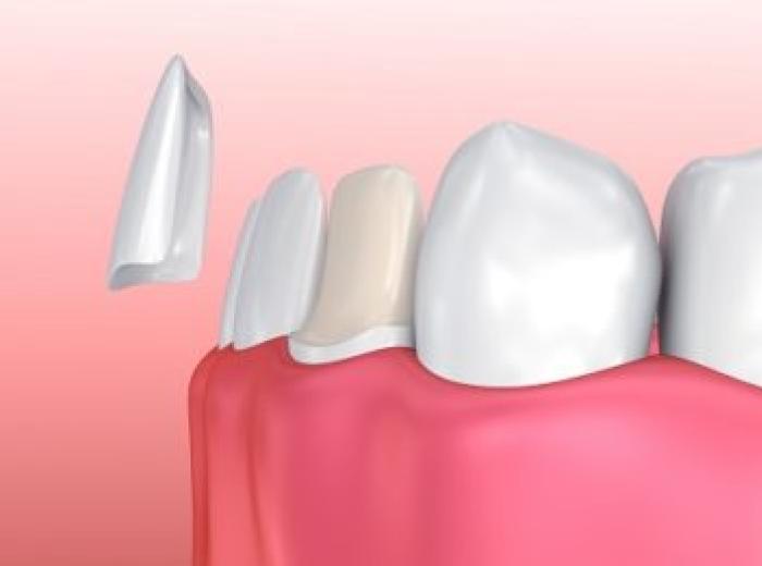 What Are Dental Veneers?
